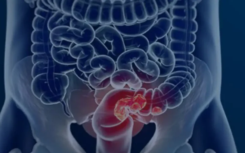 Rastreamento para câncer colorretal pode ser implementado no SUS