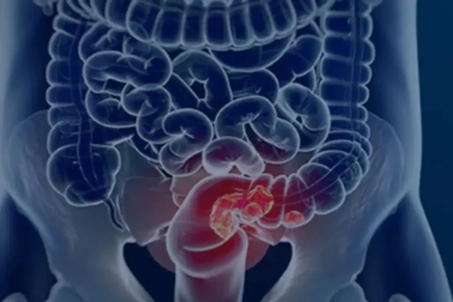 Rastreamento para câncer colorretal pode ser implementado no SUS