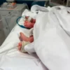 Gêmeos siameses de Palmas nascem em Goiânia e aguardam cirurgia de separação