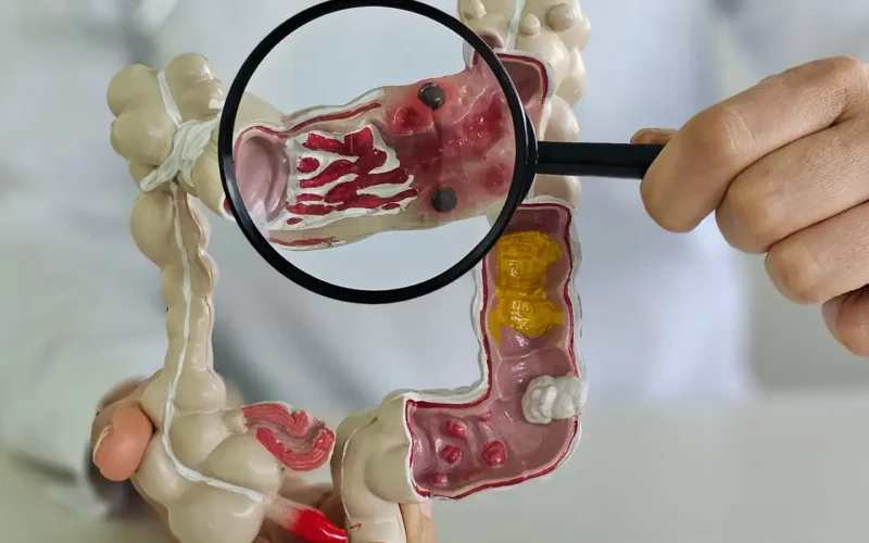 Casos de doenças inflamatórias intestinais aumentam cinco vezes no Brasil em 13 anos