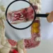 Casos de doenças inflamatórias intestinais aumentam cinco vezes no Brasil em 13 anos