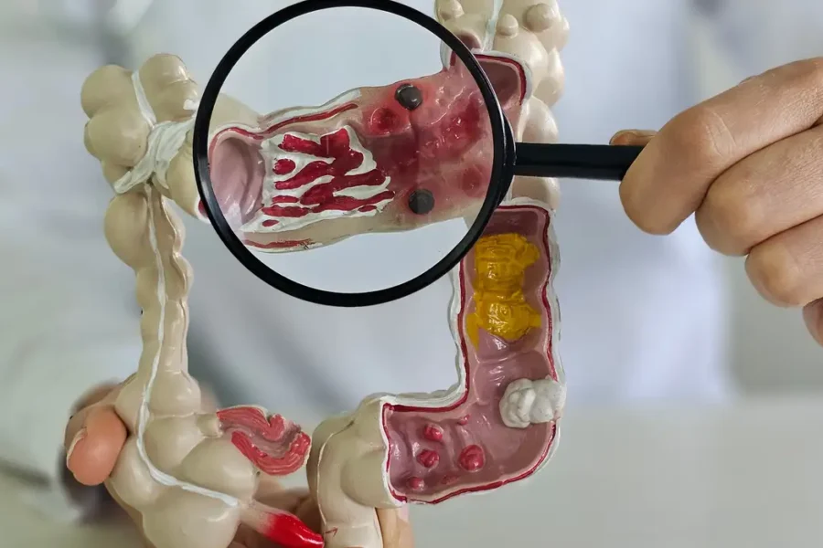 Casos de doenças inflamatórias intestinais aumentam cinco vezes no Brasil em 13 anos