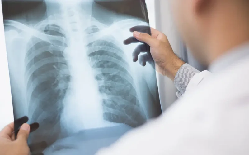 Anvisa aprova novo medicamento para câncer de pulmão avançado