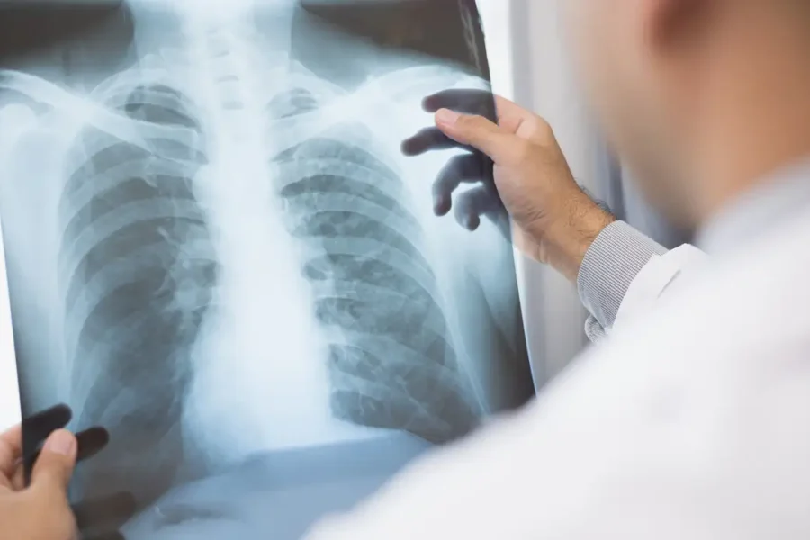 Anvisa aprova novo medicamento para câncer de pulmão avançado